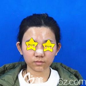 在长沙美之峰做鼻综合术后1天照