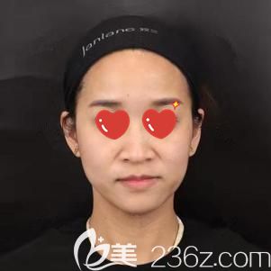 到武汉艺星去法令纹前的自己 到武汉艺星去法令纹前的自己