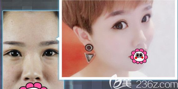 天伊美整形隆鼻手术案例 天伊美整形隆鼻手术案例