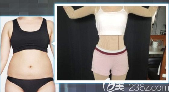 石家庄天伊美腰腹吸脂案例 石家庄天伊美腰腹吸脂案例