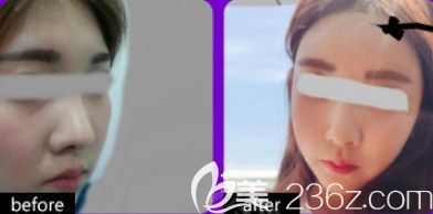 天伊美整形注射除皱案例 天伊美整形注射除皱案例