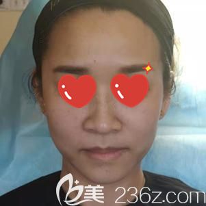 <!--<i data=20240703-sp></i>-->主任帮我做玻尿酸去法令纹术后即刻消失 <!--<i data=20240703-sp></i>-->主任帮我做玻尿酸去法令纹术后即刻消失