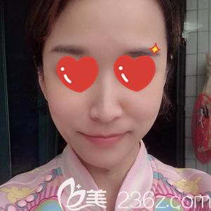 做玻尿酸去法令纹术后15天脸部变饱满自然 做玻尿酸去法令纹术后15天脸部变饱满自然