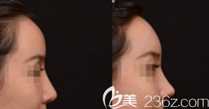 日照医疗美容医院隆鼻案例二