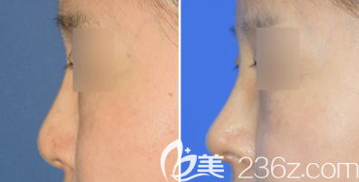 日照医疗美容医院隆鼻案例三