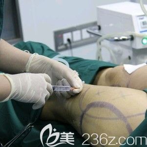 张柏松医生为我做大腿吸脂手术
