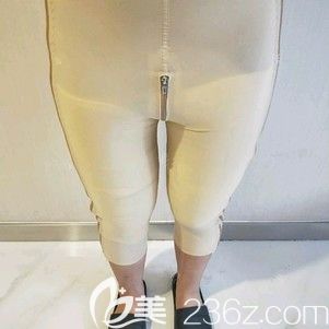 天伊美整形医生张柏松为我做大腿吸脂术后腿部肿胀