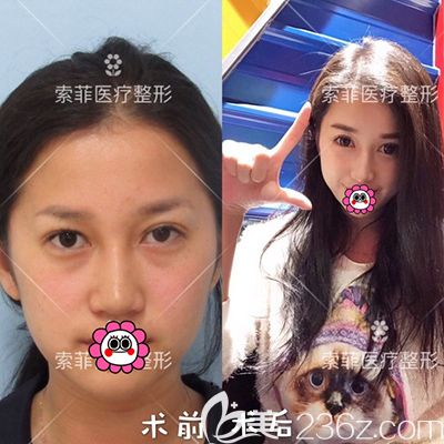 哈尔滨索菲陈富全鼻修复案例