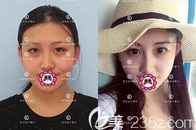 哈尔滨索菲陈富全隆鼻效果对比