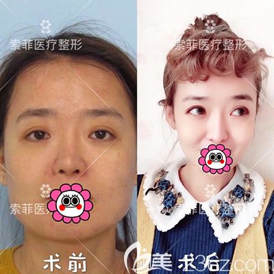 哈尔滨索菲隆鼻真人案例对比效果