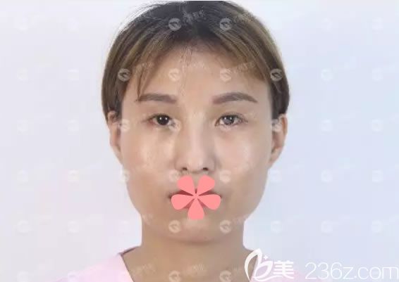 在福州名韩整形做双眼皮术前照 在福州名韩整形做双眼皮术前照