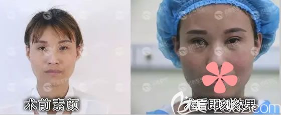 王女士术前素颜和术后即刻效果图 王女士术前素颜和术后即刻效果图