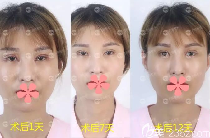 7mm全切双眼皮恢复过程图 7mm全切双眼皮恢复过程图