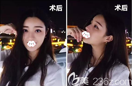 <!--<i data=20240703-sp></li>
<li><i data=20240703-sp></i>-->鼻综合术后恢复照片