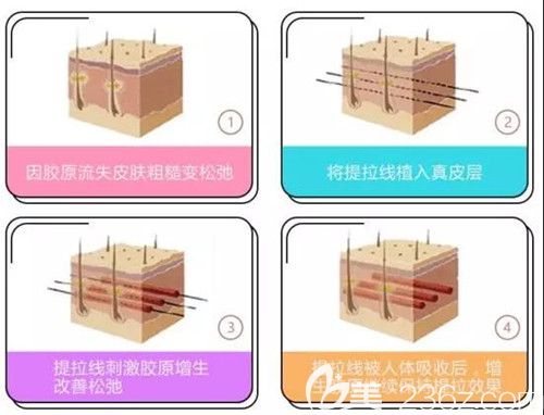 埋线提升的原理
