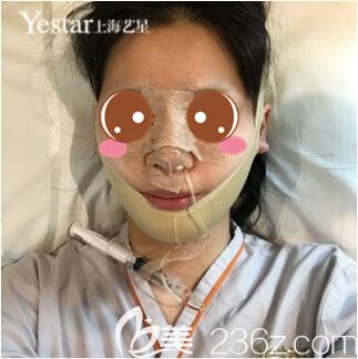 上海艺星许炎龙宫廷复合隆鼻+面部吸脂真人案例术后第3天