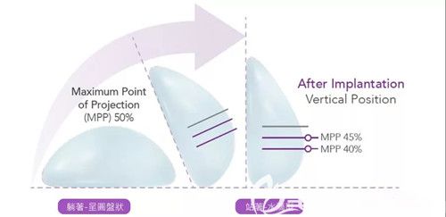 魔滴假体形态为水滴形和圆形 魔滴假体形态为水滴形和圆形