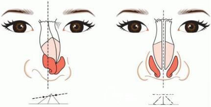 隆鼻塑鼻尖应该选择那些材料 隆鼻塑鼻尖应该选择那些材料