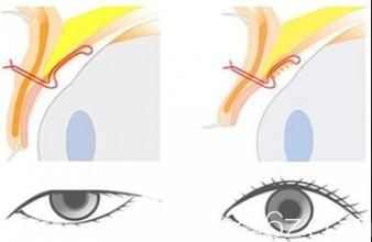 矫正上睑下垂手术示意图