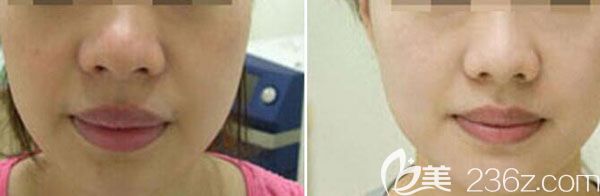 2唐文齐院长做厚唇改薄两年后案例效果对比图 2唐文齐院长做厚唇改薄两年后案例效果对比图