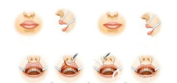 厚唇改薄术后会留疤痕吗? 厚唇改薄术后会留疤痕吗?