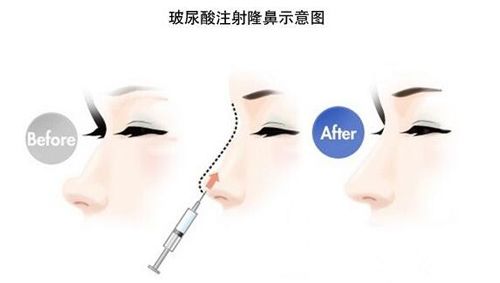 玻尿酸隆鼻整形手术步骤原理图 玻尿酸隆鼻整形手术步骤原理图