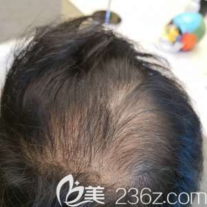 到武汉艺星做发际线种植前自己稀疏的头发 到武汉艺星做发际线种植前自己稀疏的头发