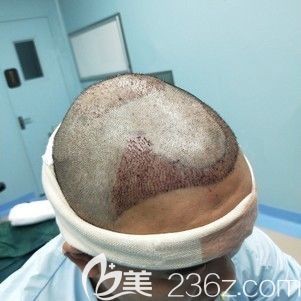 <!--<i data=20240703-sp></i>-->主任帮我做发际线种植术后即刻 <!--<i data=20240703-sp></i>-->主任帮我做发际线种植术后即刻