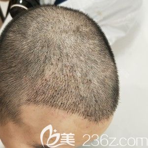 做发际线种植术后15天肿胀消失 做发际线种植术后15天肿胀消失