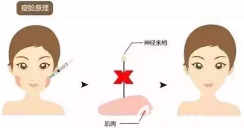 注射瘦脸瘦脸原理