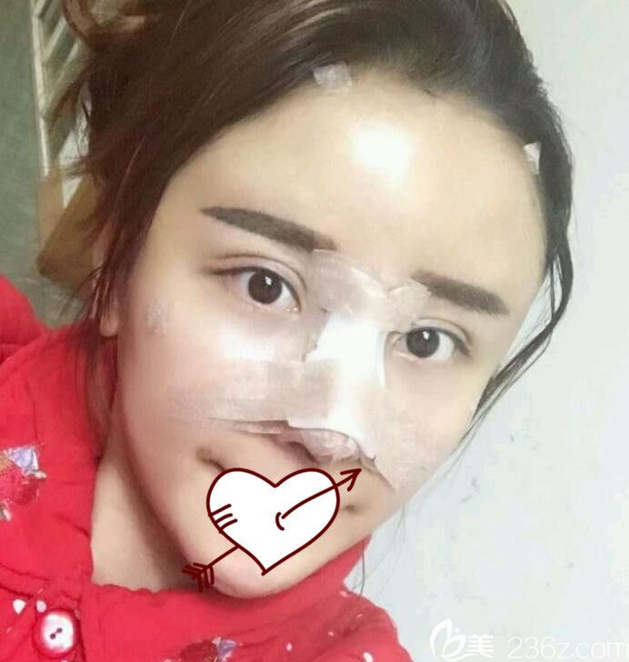 找合肥壹美尚整形<!--<i data=20240703-sp></i>-->做假体隆鼻失败修复手术第1天 找合肥壹美尚整形<!--<i data=20240703-sp></i>-->做假体隆鼻失败修复手术第1天