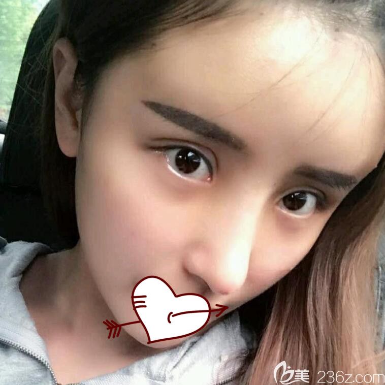 <!--<i data=20240703-sp></i>-->做隆鼻失败修复术后第5天 <!--<i data=20240703-sp></i>-->做隆鼻失败修复术后第5天