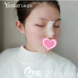 上海艺星许炎龙切开双眼皮+假体隆鼻真人案例术后第5天