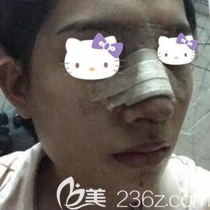 做鼻综合与假体隆下巴整形术后3天照片