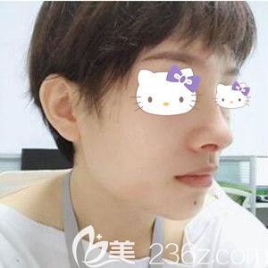 在华美做鼻综合术后一周拆线效果图