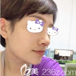 在海南华美做自体软骨鼻综合与假体垫下巴术后半个月效果照