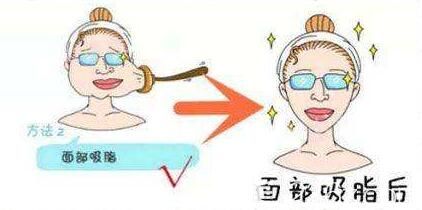 面部吸脂原理