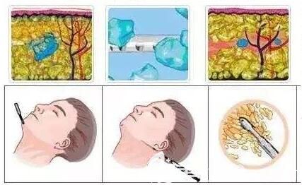 面部吸脂多久能瘦脸