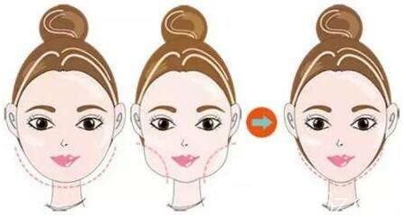 面部吸脂后皮肤会松弛吗？