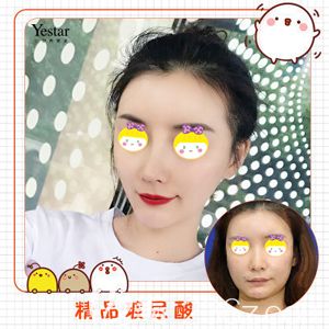 武汉艺星注射玻尿酸术前术后对比效果 武汉艺星注射玻尿酸术前术后对比效果