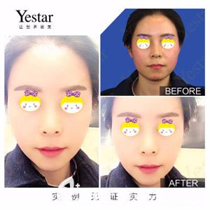 艺星洪霞医生做射频紧肤术后面部松弛改善明显 艺星洪霞医生做射频紧肤术后面部松弛改善明显