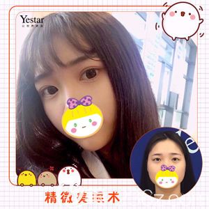 主任做切开双眼皮术后眼睛线条自然流畅 主任做切开双眼皮术后眼睛线条自然流畅