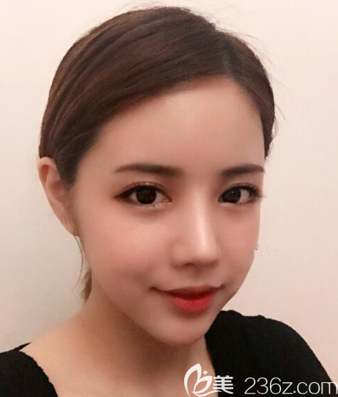 韩国朱诺整形金信荣：鼻部+外眼角+童颜手术后三个月太满意了想向所有人介绍它