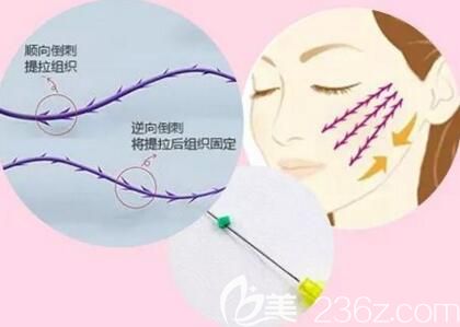 埋线提升效果好不好？埋线提升是不是用线越多越好?