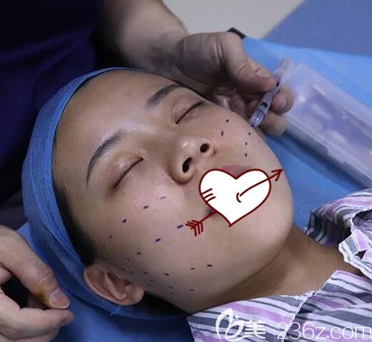 合肥台美丽格叶凡给我做埋线提升术前设计