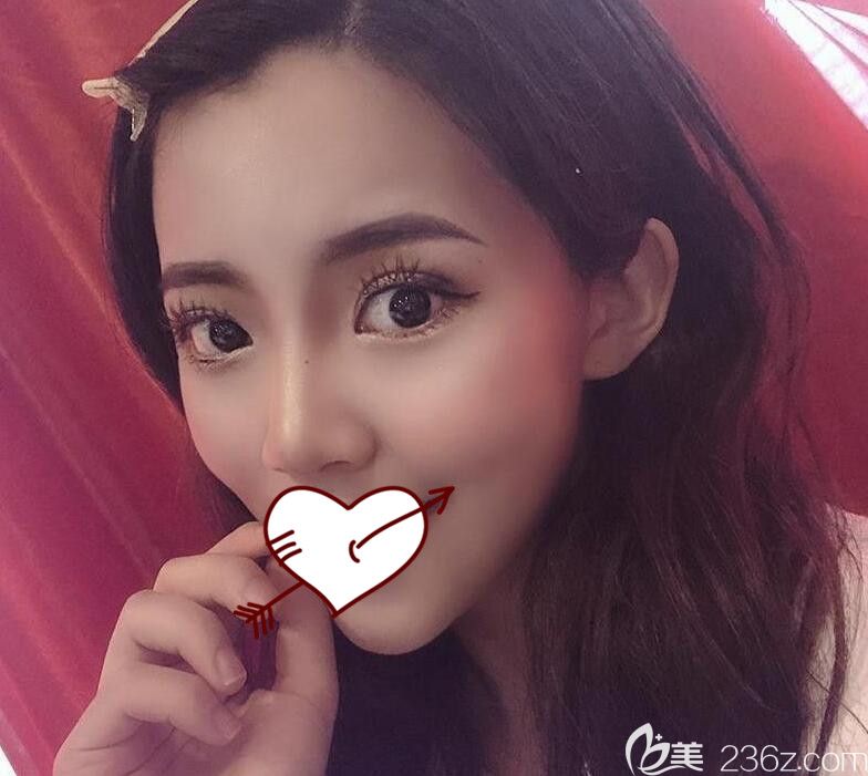 面部埋线提升术后10天恢复情况