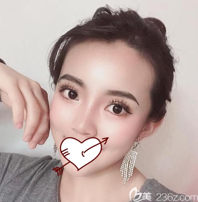 台美丽格整形埋线提升第25天变化图