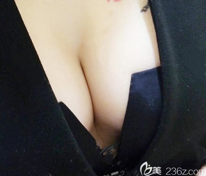 合肥台美丽格整形隆胸术后第15天恢复图
