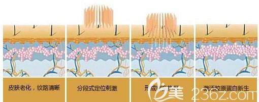 点阵激光去妊娠纹原理分解图