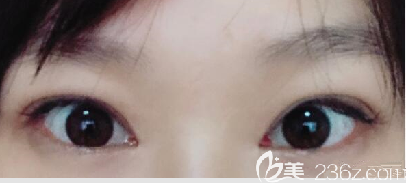 估计我是韩国bio曹仁昌眼修复最详细的手术纪实案例了我做的眼皮修复+提肌